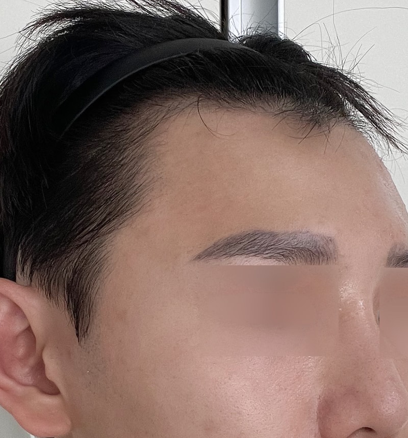 디에이 비절개모발이식 수술 4일차까지 변화공유~
