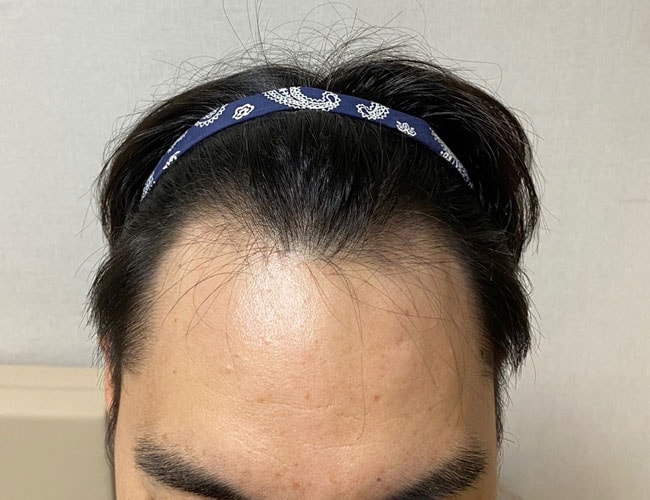 비절개 투블럭컷 2873모 2일차
