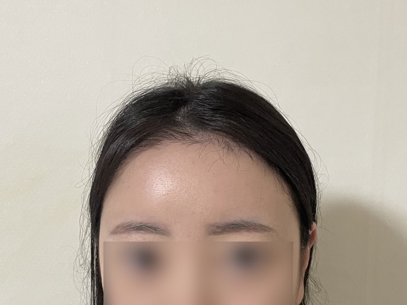 ディーエー 女性 毛髪移植 混用 4500毛 2ヶ月目 暗黒期がないようだww