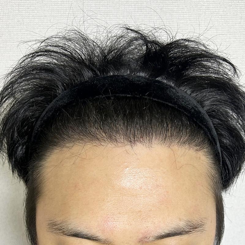 Director Lee Dong-wook of DA, M-ja + head hair loss mix 5,500 Mo 8 months review