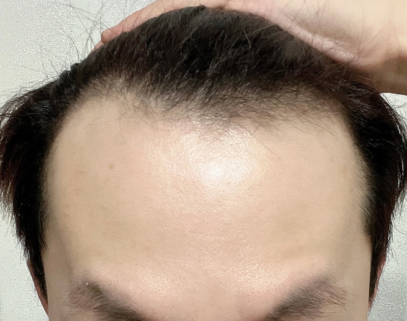 非切开3000毛，是1年~