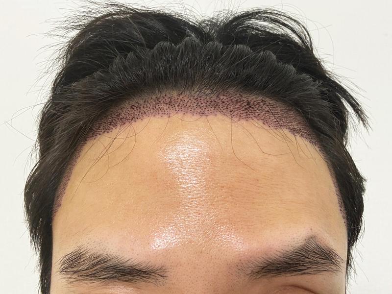 디에이 비절개 모발이식 투블럭컷 3000모 3일차에요!