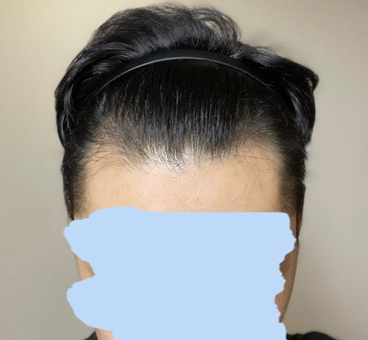 M-shaped hair loss hairline hair transplant has been 1 year and 5 months.