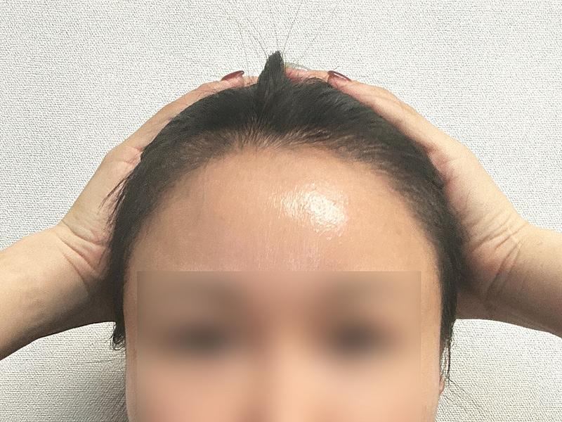 DA混用女性毛髪移植4000毛暗黒期なしで3ヶ月目ですね！！