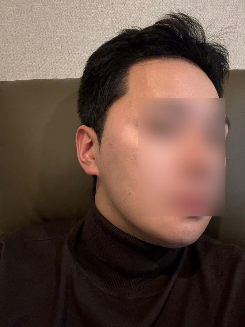 非切開毛髪移植3000本、4ヵ月後のレビューです。
