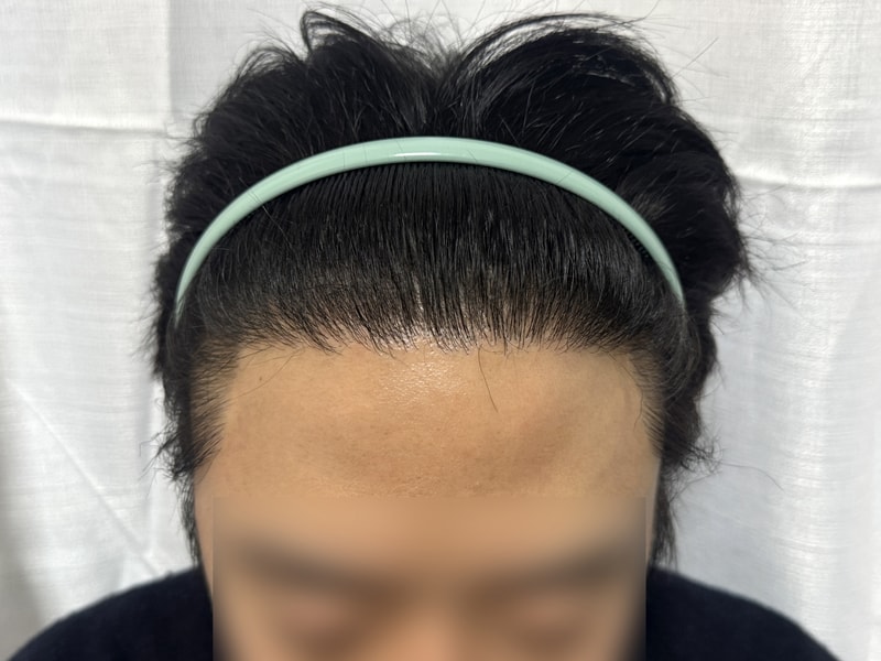 DA non-cut Hair Transplant two-block cut 3000 Mo is 11 months old.