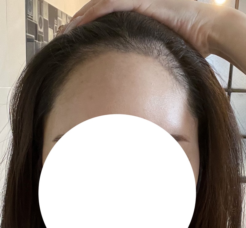 My forehead has decreased by 3cm. ♥️