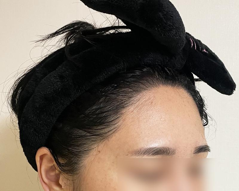 헤어라인이식 절개 2000모 1년 채웠어요!!