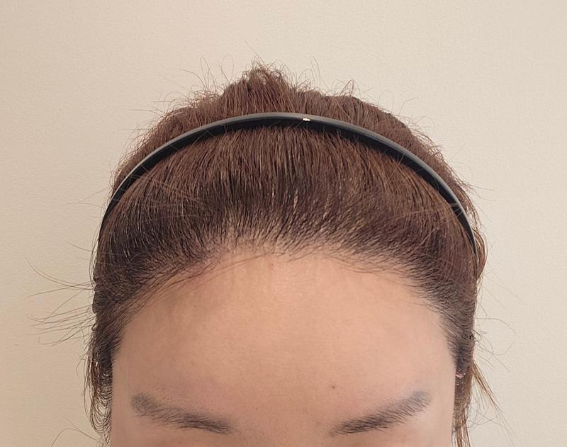 カットヘアライン+もみあげ3000毛7ヶ月目！！