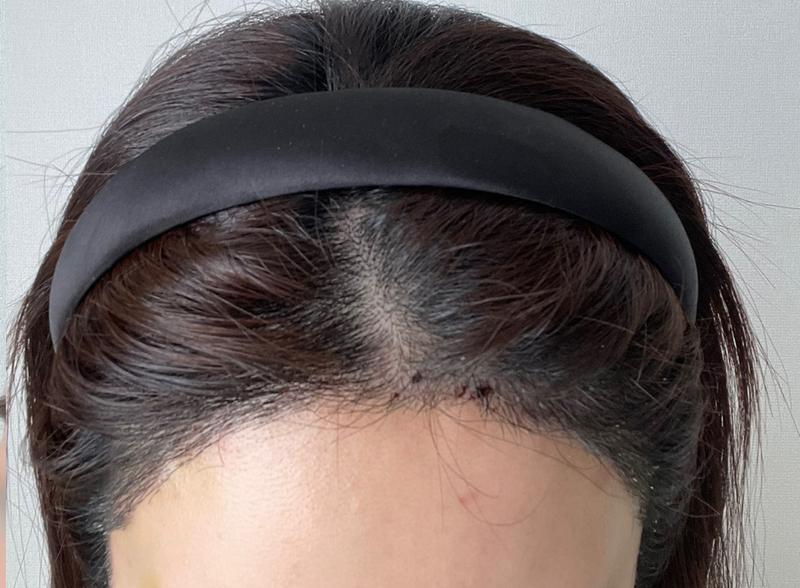 ヘアライン 毛髪移植 再手術 1週間経過（かさぶた注意）