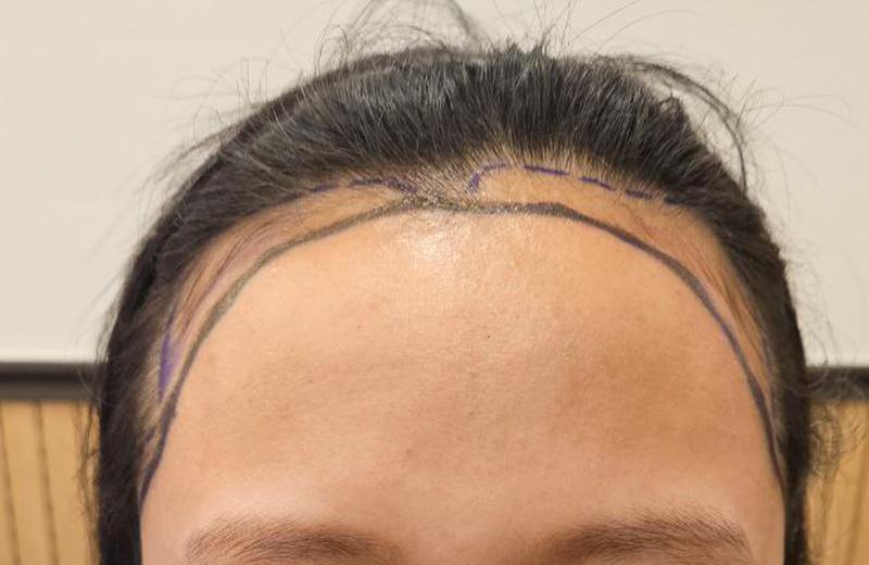 Review of Women's Hairline Correction Hair Transplantation