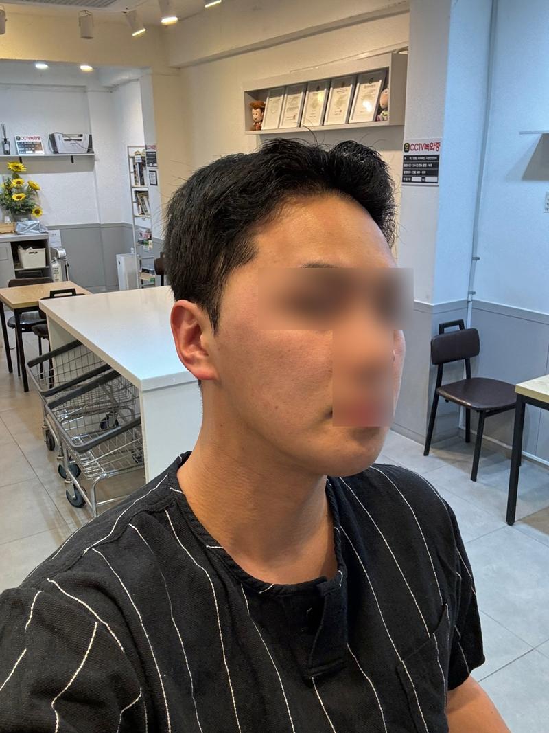 男性ヘアライン矯正 毛髪移植6ヶ月経過