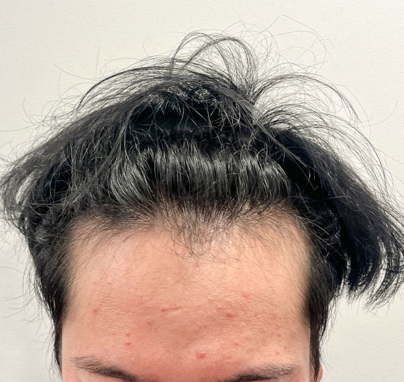 비절개 투블럭컷 2800모 이동욱원장님, 수술직후 입니다.