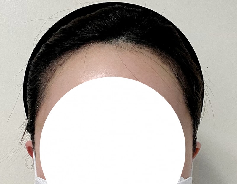 Reinforced hairline with non-cut 1,500 hairline!