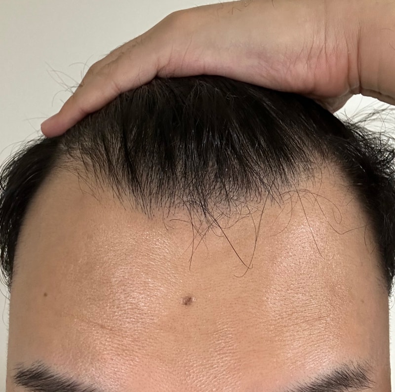 Men's non-cut micro-cut 2,200-mo surgery is complete.