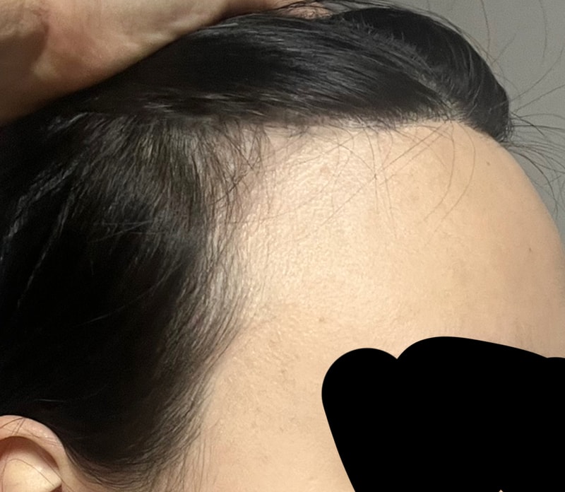 3,000 hairs of incision (comparison of the process before surgery to the second month!)