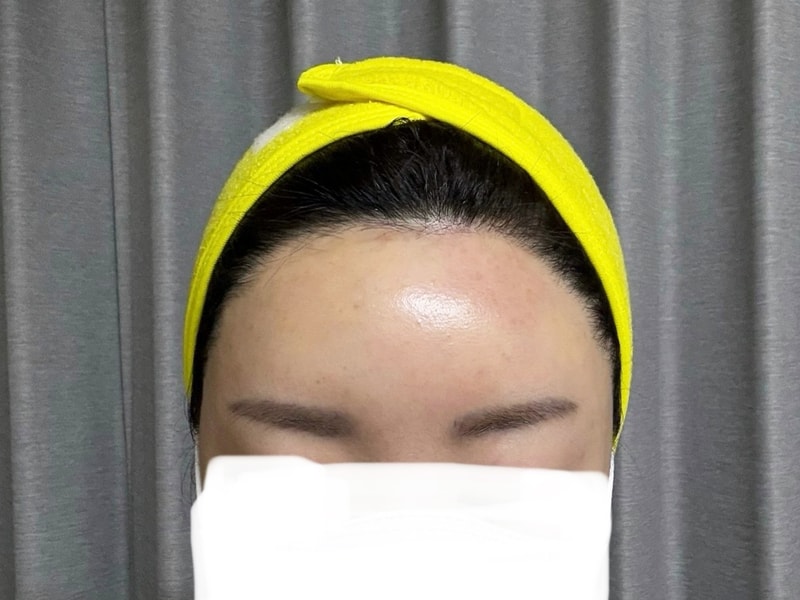 DA 非切開（ノーカット） 毛髪移植 2541毛 1年半経過♥♥♥