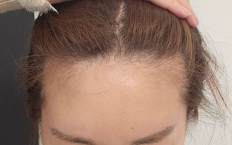 切開ヘアライン+もみあげ3000本