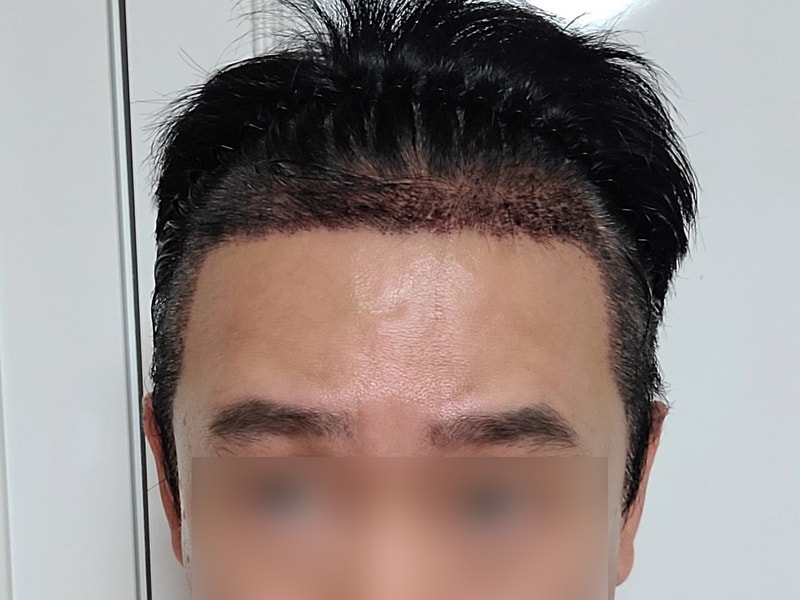 DA 毛髪移植 混用 4200毛(切開2500毛+非切開 ボックスカット1700毛) 一週間目です