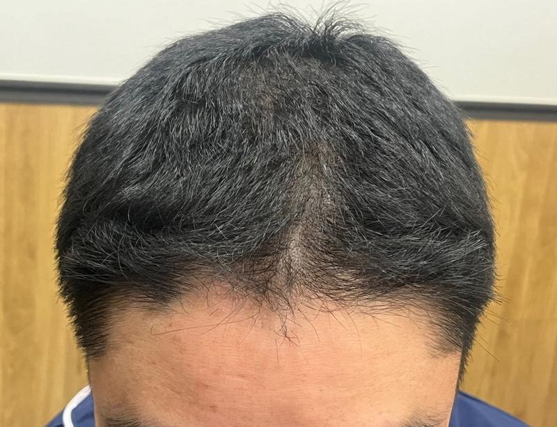 毛髪移植2200毛、7週間が過ぎた膳