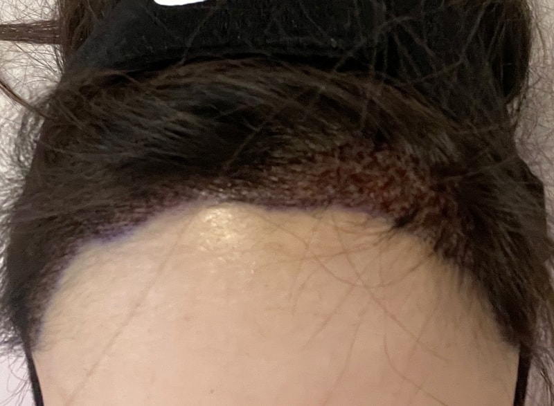 This is a surgical procedure of 2000 hairline for women with half of their foreheads. ^_^
