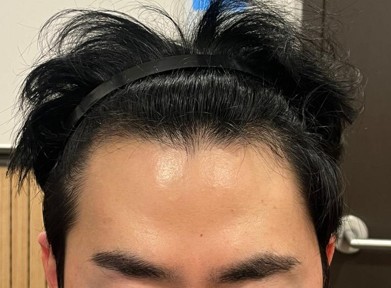 ヘアライン1000毛の毛髪移植が7日になりました。