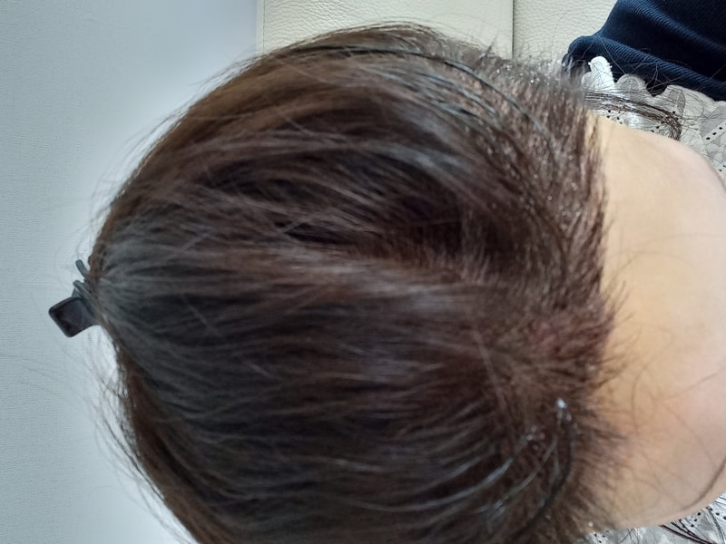 모발이식 절개로 했어요