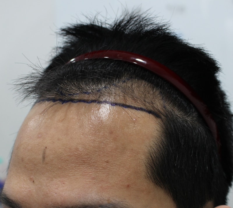 수술전 옆면.jpg