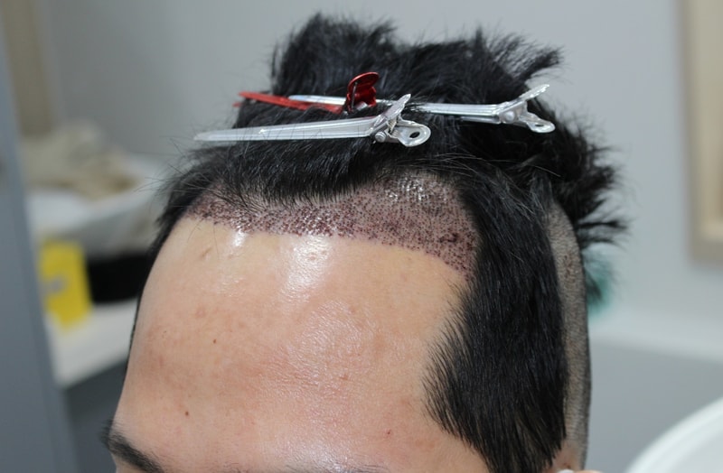 1일차 샴푸후 옆면.jpg