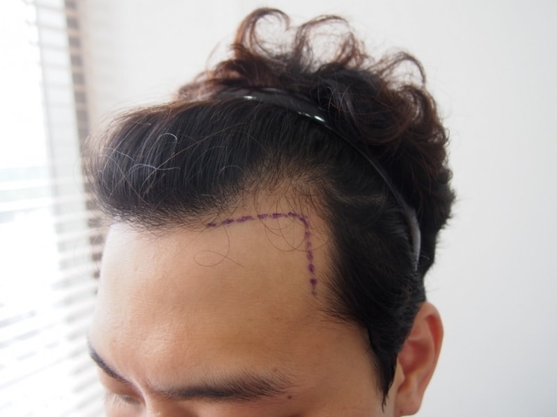 크기변환_수술전왼쪽.JPG