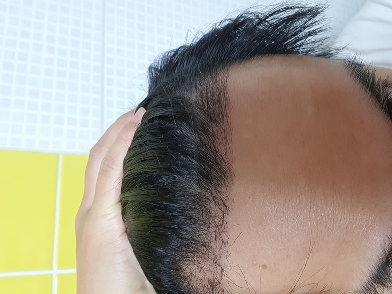 M字非切開の1ヵ月後のレビューです