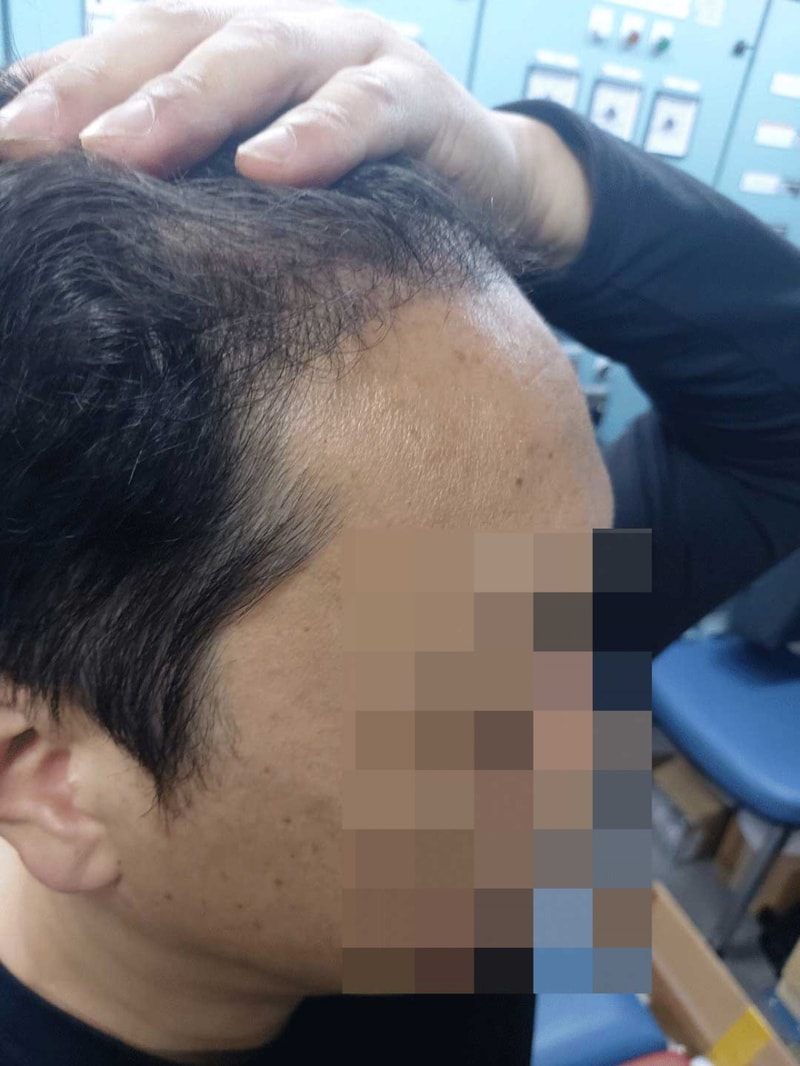 [크기변환]수술-4개월차-측면.jpg