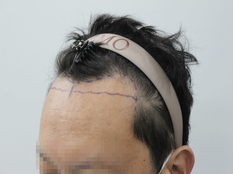 [크기변환]수술-전-헤어라인.jpg