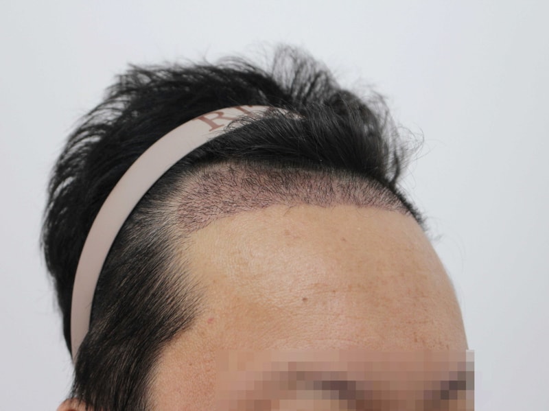 [크기변환]수술-2주후-측면.jpg