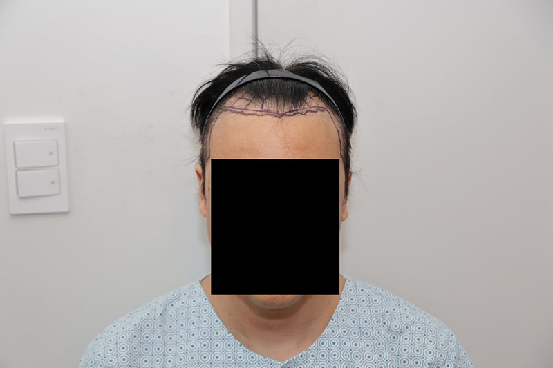 NEWHAiR (Seoul) / incisional ceremony / 2500 cap / 6th day review.