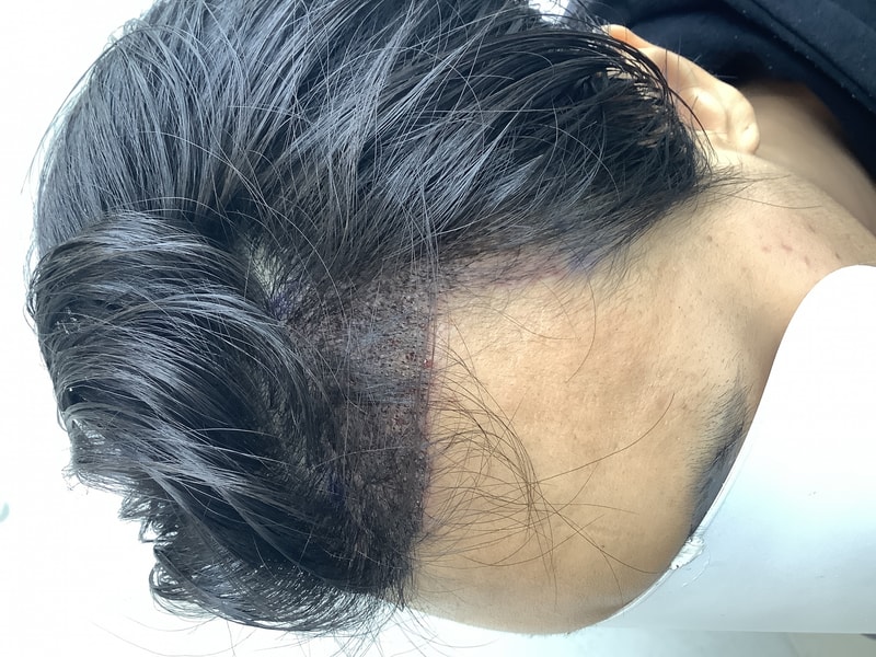 1st day after shampooing JARADA CLINIC 2200 hair follicles
