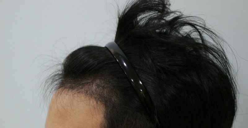 수술후1.jpg