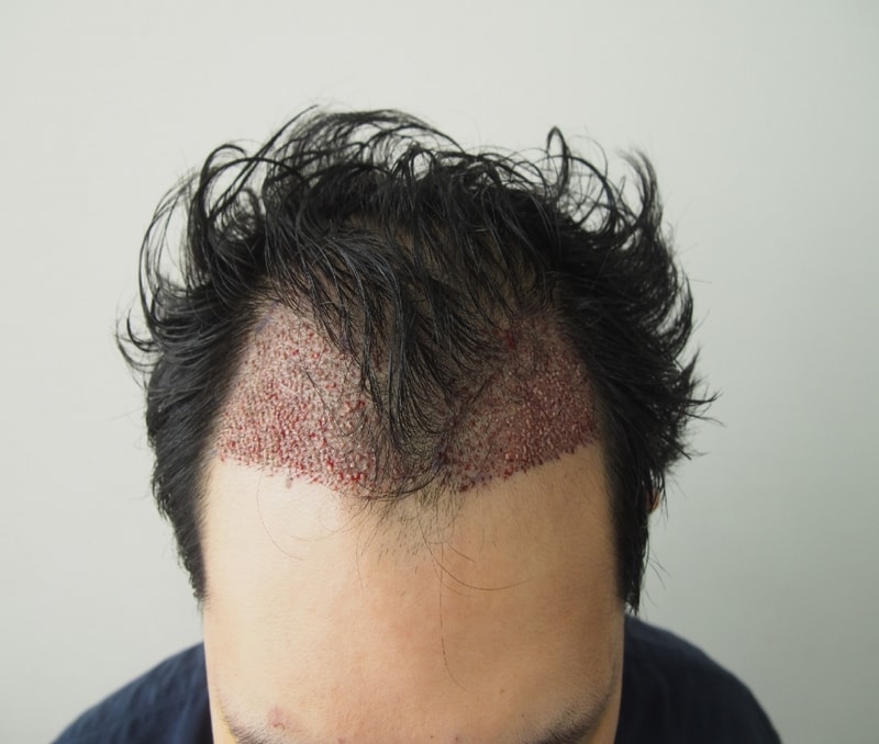 1300 hair follicles were finally operated on March 25th