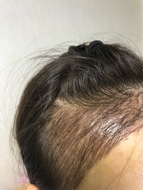 뉴헤어 10일차 실밥풀고입니당