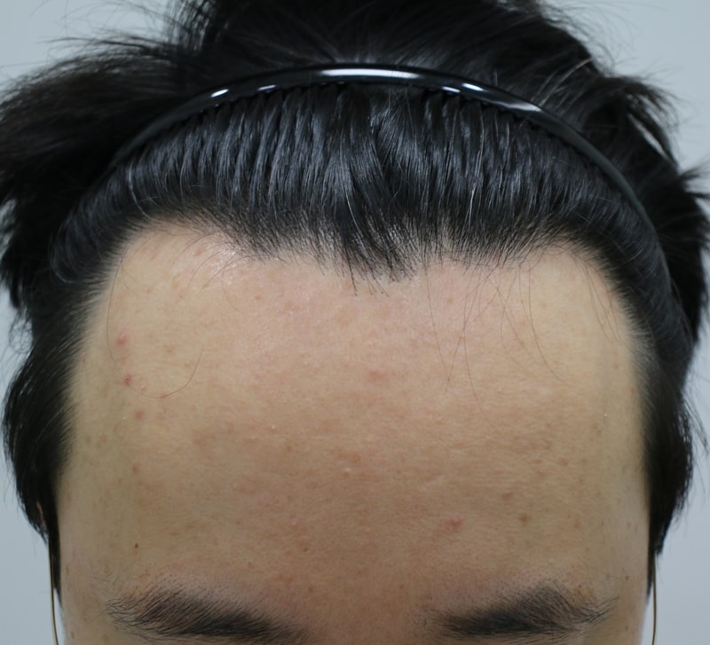 I leave a review of the 1st month of M-shaped hair transplantation.