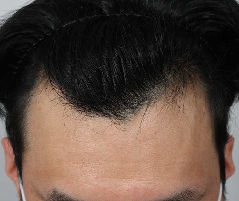 m-shaped incisional hair transplantation 7 months later