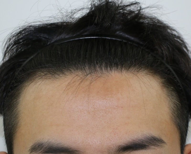 비절개모발이식 800모낭 5개월차 지났습니다