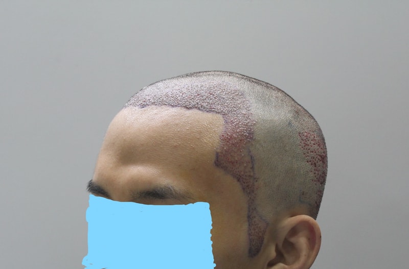 Inked수술직후 8_LI.jpg