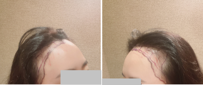 2수술당일디자인.png