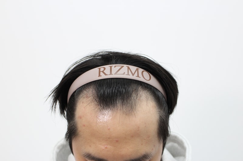 부산 리즈모 240일 경과 후기입니다