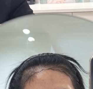 모발이식 후기입니다