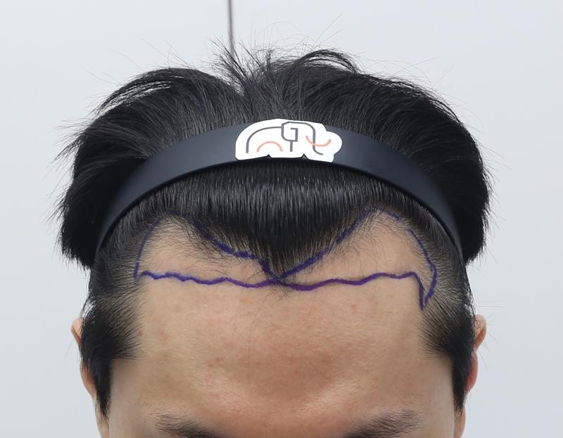 압구정 맘모스헤어라인에서 비절개슬릿 M자 모발이식 10개월경과 후기입니다.