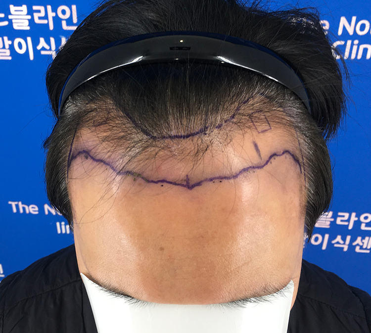 노블라인 m자 각질제거 후기