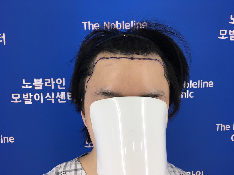수술받은지 3달이 다 되어갑니다.