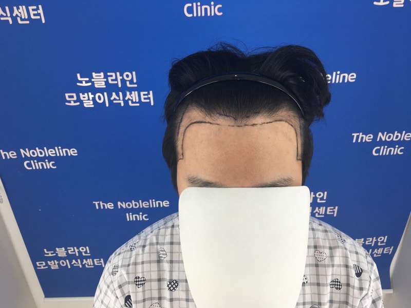 유튜브 꾸준히 보다가 이번에 M자 수술 받았습니다.